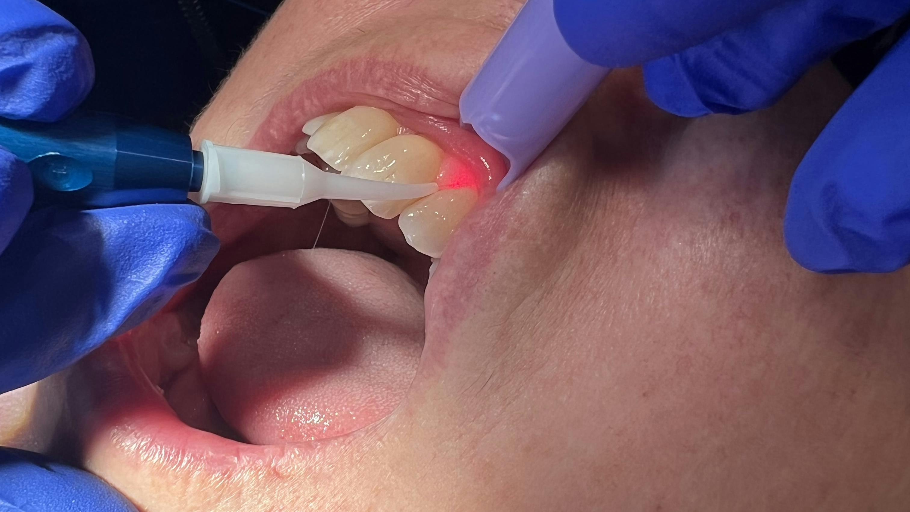 dental lasers