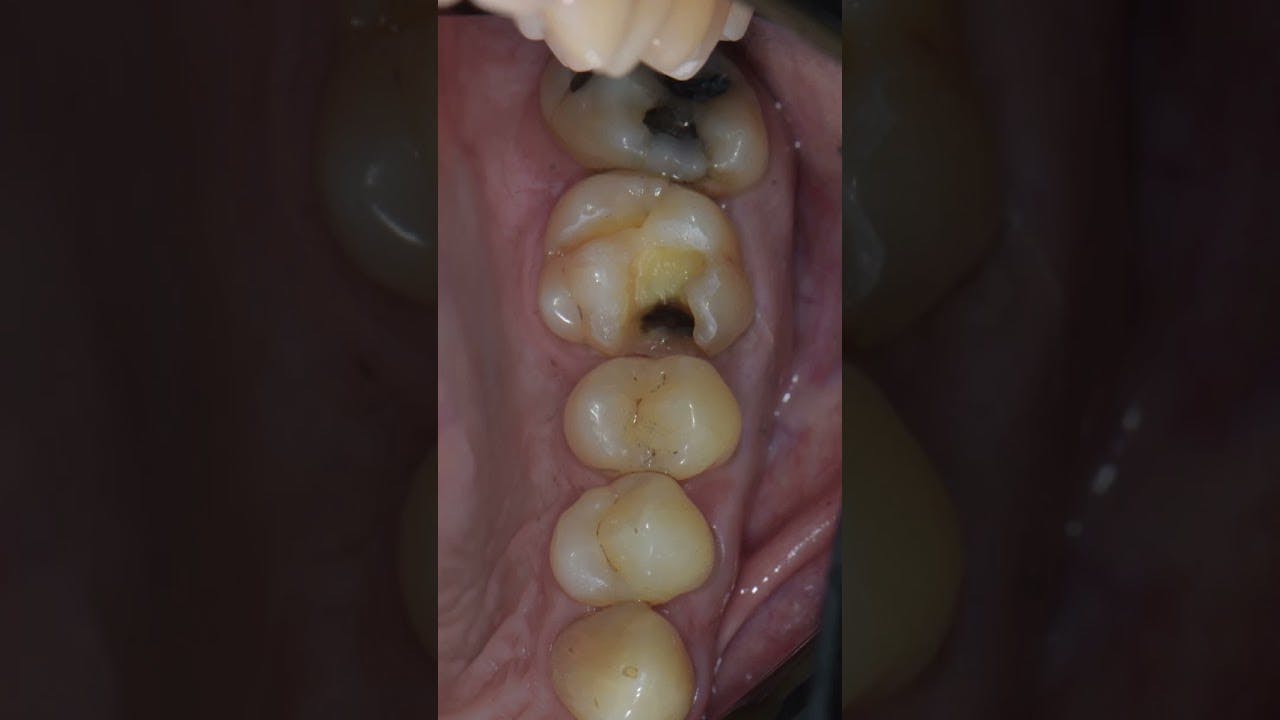 What all simple and conservative tooth preps start with