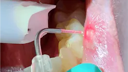 lasers in dentistry lasers in dentistry