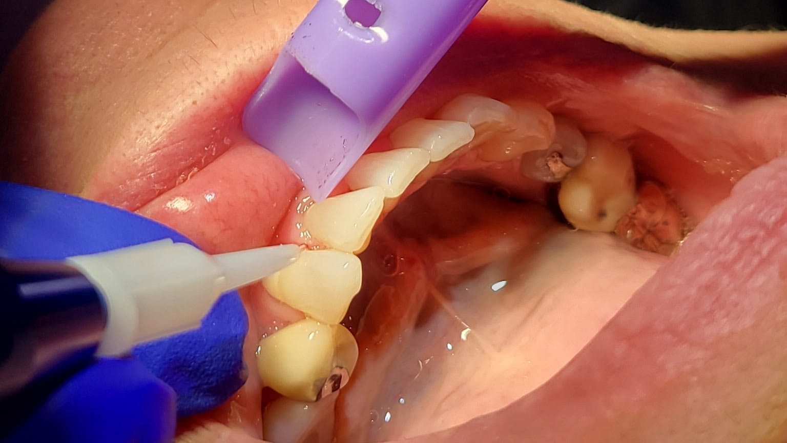 a dental laser being used on a patient
