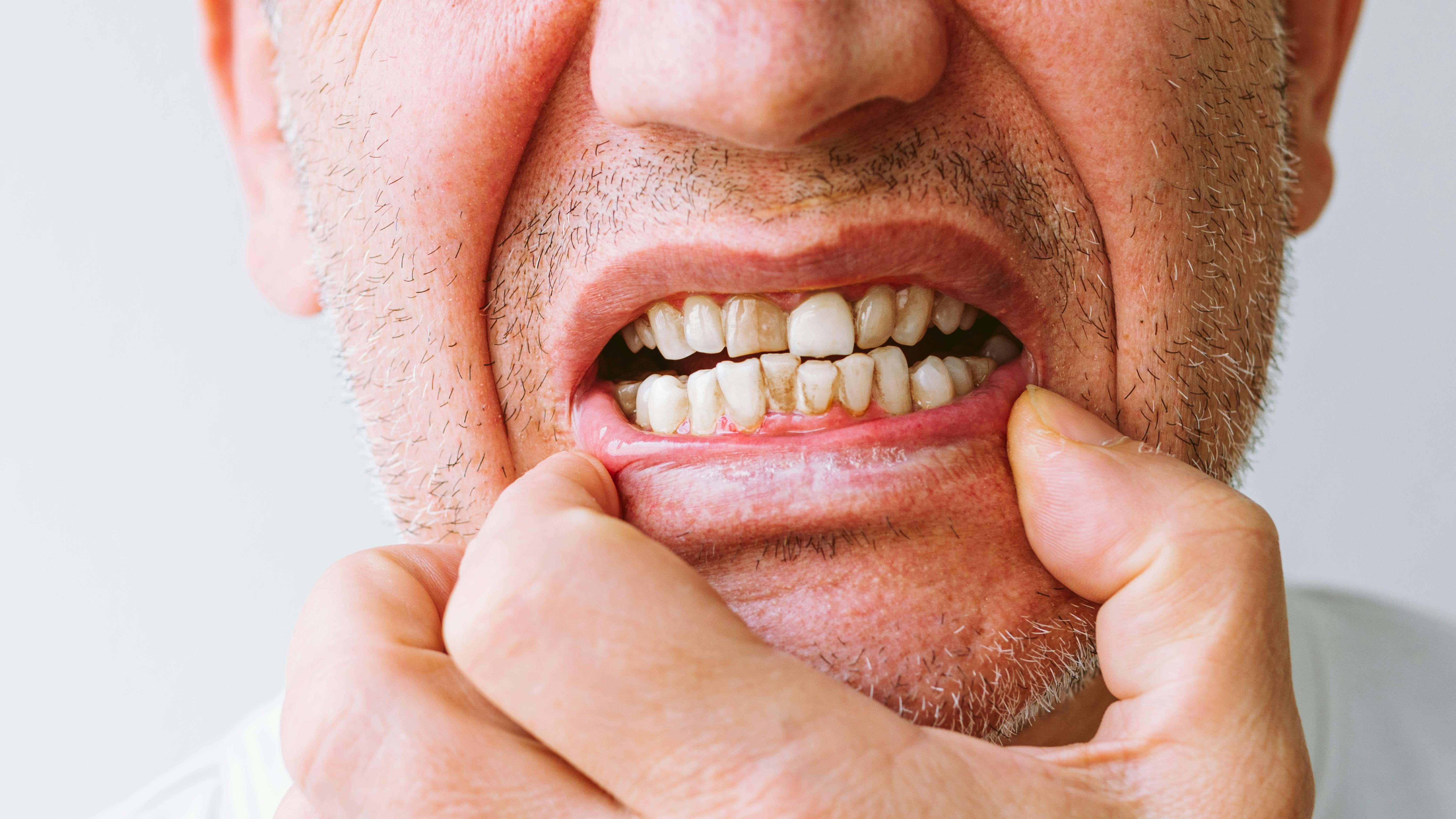 Dental patient with poor oral health