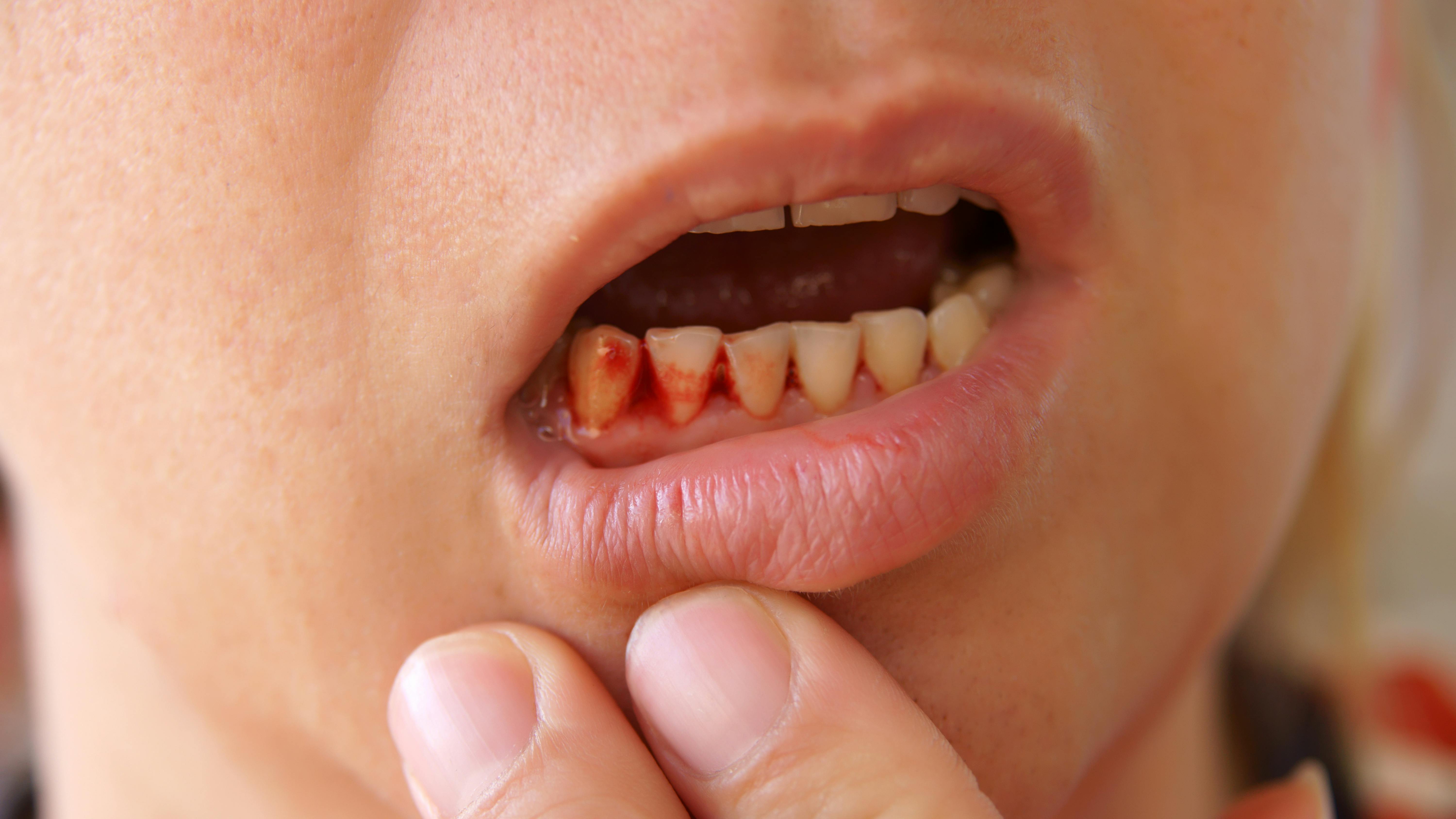 person with bleeding gums