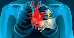 Piezo-Based Energy Harvesting for Medical Implants May Transcend Alternative Approaches Piezo-Based Energy Harvesting for Medical Implants May Transcend Alternative Approaches