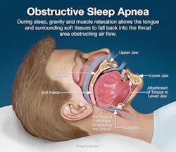 Obstructive sleep apnea During sleep gravity and muscle relaxation allows the tongue and surrounding tissues to fall back into the throat area obstructing air flow Photo courtesy of Dear Doctor Inc Obstructive sleep apnea During sleep gravity and muscle relaxation allows the tongue and surrounding tissues to fall back into the throat area obstructing air flow Photo courtesy of Dear Doctor Inc