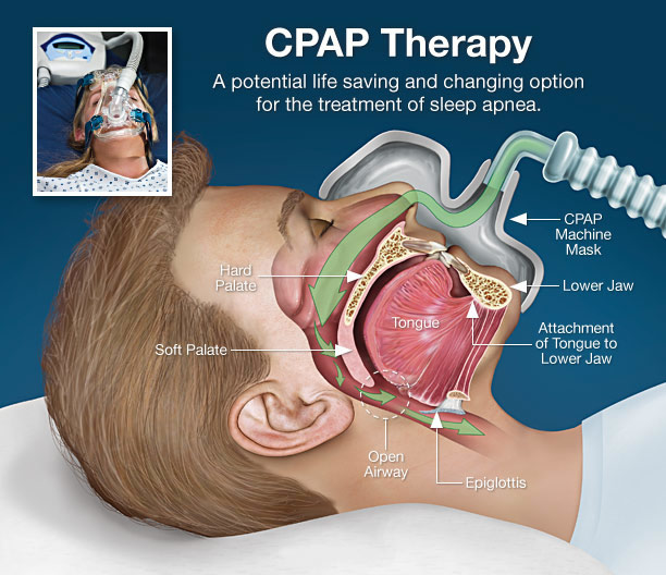 cpap machine