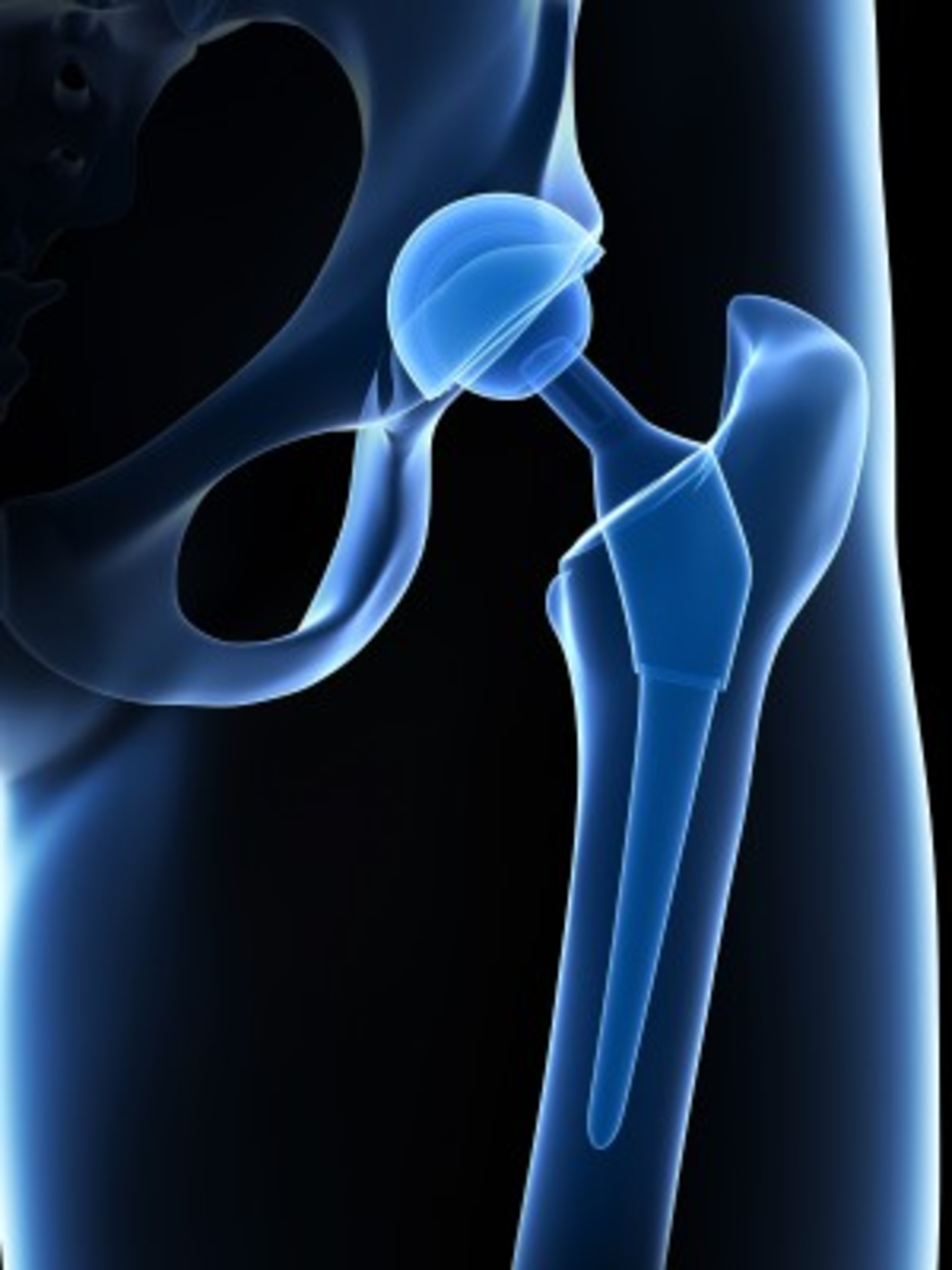Hip Implant S