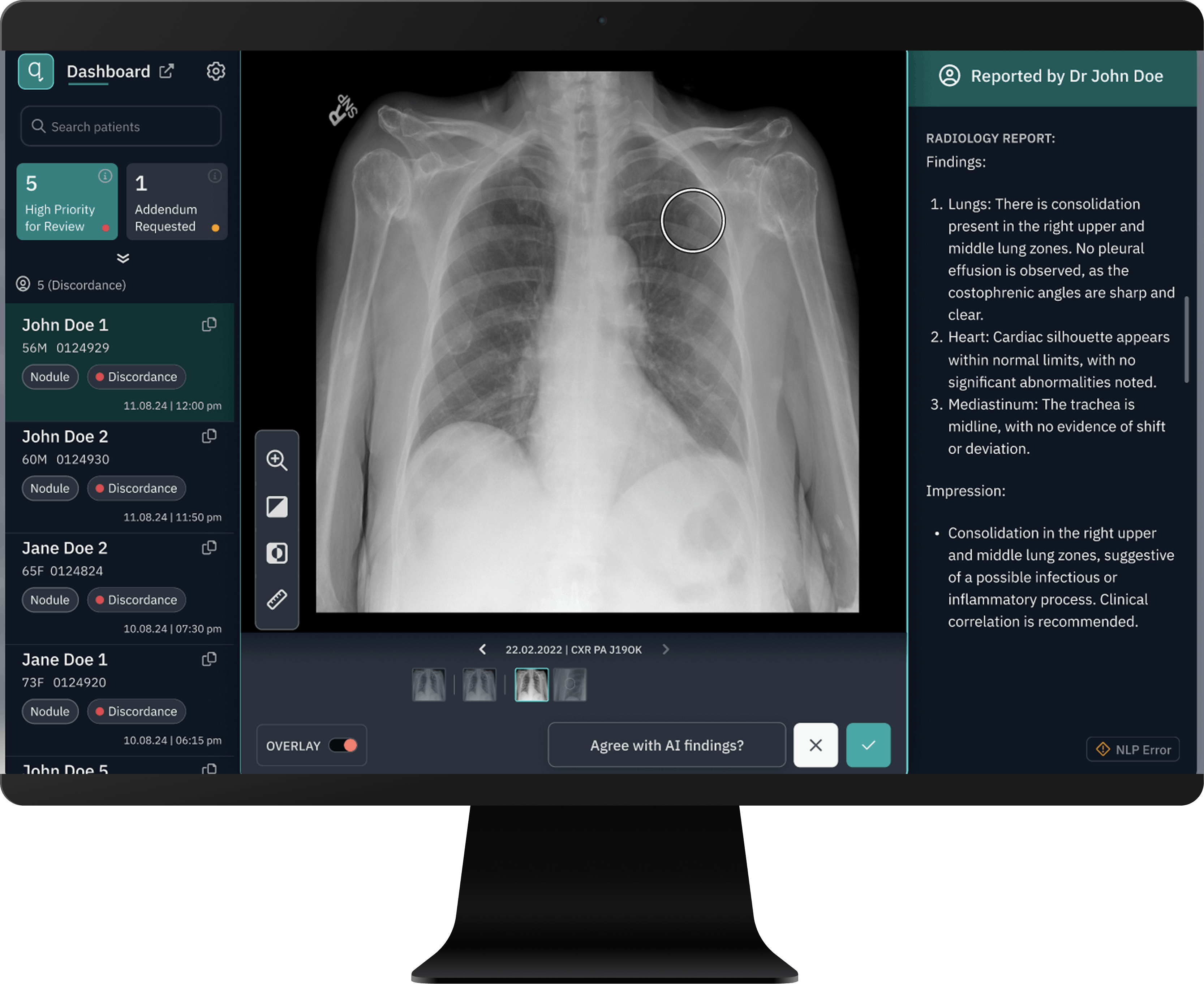 University Hospitals Cleveland Medical Center is comparing an algorithm's ability to detect pulmonary nodules to a radiologist&rsquo;s interpretation of the same chest X-rays.
