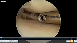 Ip Image Stream Knee Arthroscopy Ip Image Stream Knee Arthroscopy