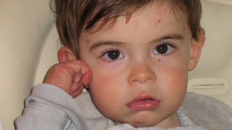 Jackson has recessive dystrophic epidermolysis bullosa, a painful and incurable blistering disorder.