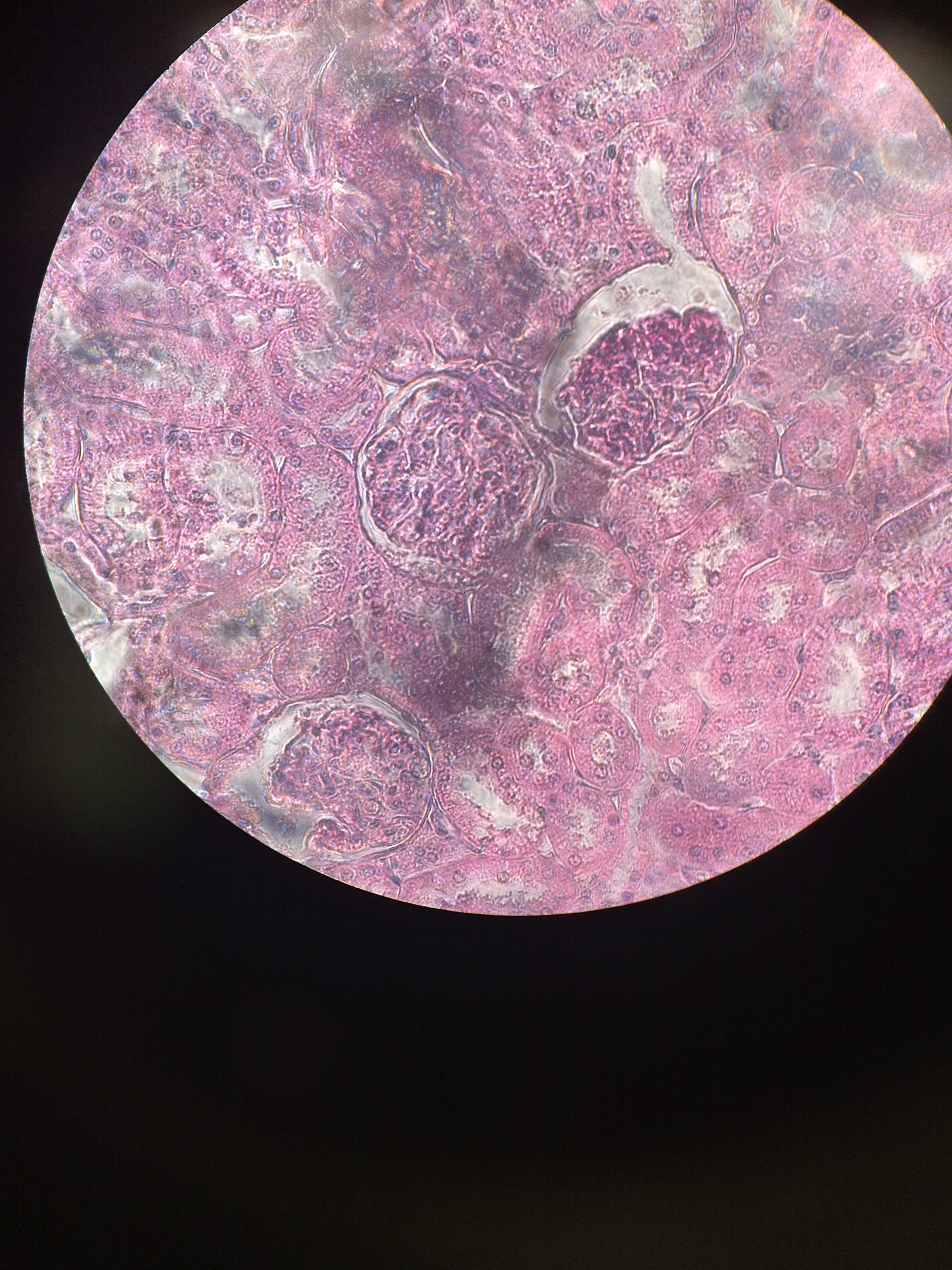 Dana Farber Novel Targeted Drug Shows Promise In Advanced Kidney Cancer Pic 2 18 20du 6368758695 30d3d56569 O Flickr Fda 5e4c1126a1f2b