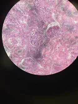 Dana Farber Novel Targeted Drug Shows Promise In Advanced Kidney Cancer Pic 2 18 20du 6368758695 30d3d56569 O Flickr Fda 5e4c1126a1f2b Dana Farber Novel Targeted Drug Shows Promise In Advanced Kidney Cancer Pic 2 18 20du 6368758695 30d3d56569 O Flickr Fda 5e4c1126a1f2b