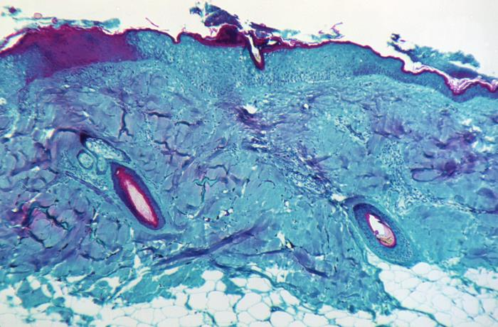 CDC and Texas confirm monkeypox In U.S. traveler