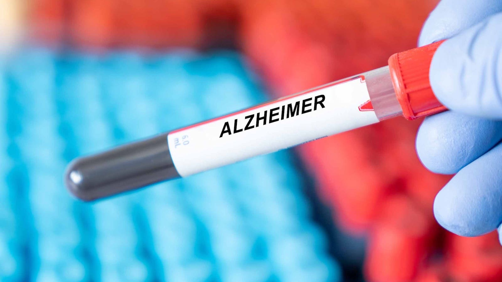Blood Test Alzheimers 63b83ceadcb0c