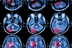 6719152be1f9fb8f1b2d1a7c Tumor 6719152be1f9fb8f1b2d1a7c Tumor