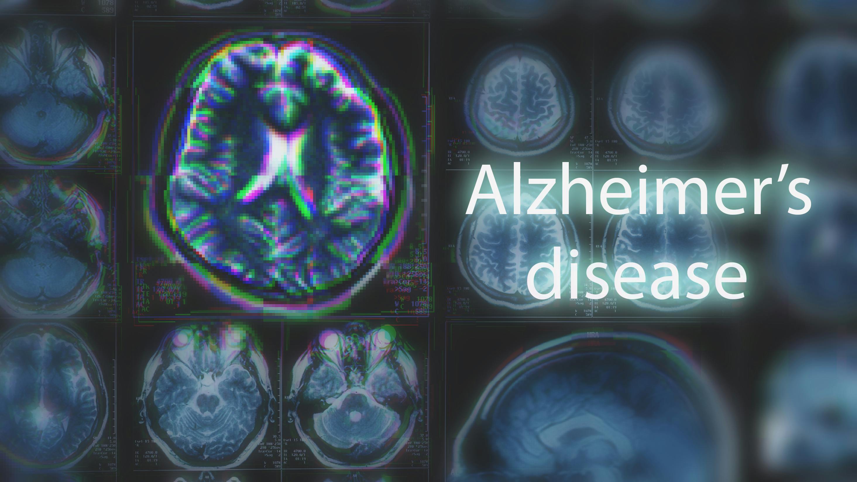 alzheimers_2