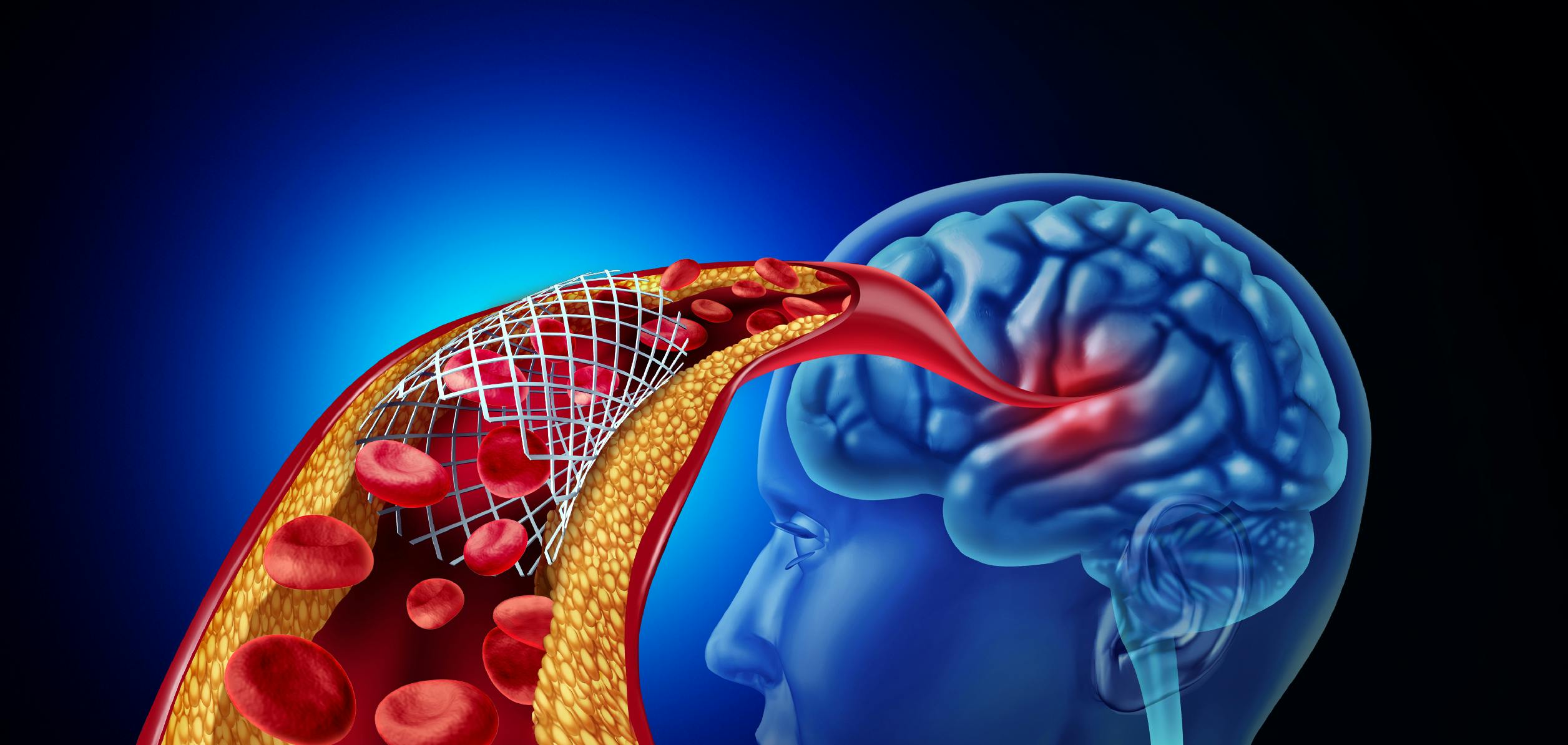 Neurovascular Stenting