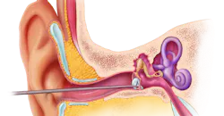 PhonoGraft being inserted into ear. PhonoGraft being inserted into ear.