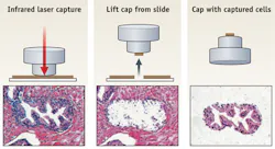 Laser-capture microdissection is an example of a highly successful technology transfer effort involving industry and National Institutes of Health. The original approach uses an infrared laser to activate the EVA polymer placed on top of the target cells (left). The cap with the EVA polymer is removed from the tissue section (center), taking with it the captured cells (right), from which biomolecules can be extracted. Laser-capture microdissection is an example of a highly successful technology transfer effort involving industry and National Institutes of Health. The original approach uses an infrared laser to activate the EVA polymer placed on top of the target cells (left). The cap with the EVA polymer is removed from the tissue section (center), taking with it the captured cells (right), from which biomolecules can be extracted.