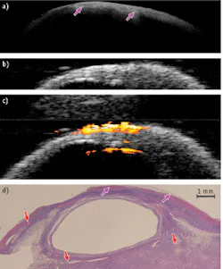 FIGURE 3. (a) OCT (12.5 × 3 mm); (b) US (12.5 × 8 mm); (c) superimposed PAI and US (12.5 × 8 mm); and (d) corresponding histology (12.5 × 5 mm) show ovarian tissue from a patient with endometriosis. The pink arrow shows a collagen bundle; the red stealth arrow points out a blood vessel. FIGURE 3. (a) OCT (12.5 × 3 mm); (b) US (12.5 × 8 mm); (c) superimposed PAI and US (12.5 × 8 mm); and (d) corresponding histology (12.5 × 5 mm) show ovarian tissue from a patient with endometriosis. The pink arrow shows a collagen bundle; the red stealth arrow points out a blood vessel.