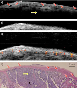 FIGURE 4. Malignant ovarian tissue from a 61-year-old patient is shown through (a) an OCT image (12.5 × 3 mm); (b) a US image (12.5 × 8 mm); and (c) a superimposed PAI and US image (12.5 × 8 mm); plus (d) corresponding histology (12.5 × 4.2 mm). The yellow diamond arrow points to the clearly malignant tissue. FIGURE 4. Malignant ovarian tissue from a 61-year-old patient is shown through (a) an OCT image (12.5 × 3 mm); (b) a US image (12.5 × 8 mm); and (c) a superimposed PAI and US image (12.5 × 8 mm); plus (d) corresponding histology (12.5 × 4.2 mm). The yellow diamond arrow points to the clearly malignant tissue.