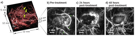 Photoacoustic imaging clearly identifies changes in blood vessels that feed a cancer tumor after administration of a therapeutic vascular disruption agent. The technique penetrates tissue to depths of 10 mm.