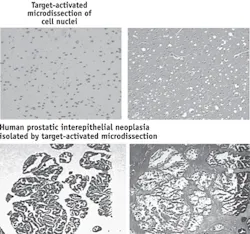 A new, high-throughput, low-cost, laser-capture microdissection technique captures specifically stained targets with light energies 50 times less than the previous LCM technique. Here, LCM captures cell nuclei (top) from human brain cells and epithelial cells from a human prostate (bottom; left and right, respectively). The new method was developed by Robert Bonner—who worked on the original LCM concept—and colleagues at NIH. A new, high-throughput, low-cost, laser-capture microdissection technique captures specifically stained targets with light energies 50 times less than the previous LCM technique. Here, LCM captures cell nuclei (top) from human brain cells and epithelial cells from a human prostate (bottom; left and right, respectively). The new method was developed by Robert Bonner—who worked on the original LCM concept—and colleagues at NIH.