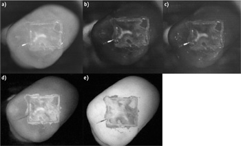 FIGURE 1. Researchers at University of California, San Francisco used Sensors Unlimited's GA1280J shortwave infrared (SWIR) camera to image the lesions on biting surfaces and between teeth. Occlusal images of one-day lesions for one sample were acquired with different filters: NIR reflectance images with crossed polarizers (a), 1300 nm (b), 1460 nm (c), and 1600 nm, along with visible reflectance image with crossed polarizers (d) and fluorescence (e).