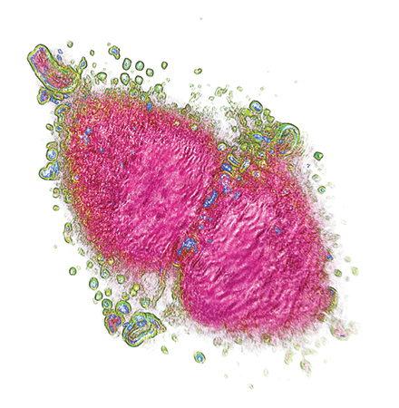 1503bow Pollaro 02 Cancer Cell