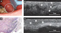 FIGURE 2. Dysplastic buccal mucosa is depicted by photography (a), in-vivo optical coherence tomography (b), and hematoxylin and eosin (H&E stain) at 10x (c). An in-vivo OCT image of normal buccal mucosa (d) enables comparison; in both OCT images, the number 1 indicates stratified squamous epithelium, 2 indicates keratinized epithelial surface layer, 3 points out basement membrane, and 4 shows the submucosa area. FIGURE 2. Dysplastic buccal mucosa is depicted by photography (a), in-vivo optical coherence tomography (b), and hematoxylin and eosin (H&E stain) at 10x (c). An in-vivo OCT image of normal buccal mucosa (d) enables comparison; in both OCT images, the number 1 indicates stratified squamous epithelium, 2 indicates keratinized epithelial surface layer, 3 points out basement membrane, and 4 shows the submucosa area.