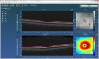 Content Dam Bow En Articles 2014 05 Oct Analysis Software By Voxeleron Leftcolumn Article Thumbnailimage Orion Advanced Optical Coherence Tomography Oct Analysis Software From Voxeleron