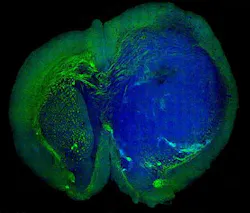 Human glioblastoma brain tumor in the brain of a mouse was made with stimulated Raman scattering (SRS) microscopy, which allows the tumor (blue) to be easily distinguished from normal tissue (green) based on faint signals emitted by tissue with different cellular structures. Human glioblastoma brain tumor in the brain of a mouse was made with stimulated Raman scattering (SRS) microscopy, which allows the tumor (blue) to be easily distinguished from normal tissue (green) based on faint signals emitted by tissue with different cellular structures.