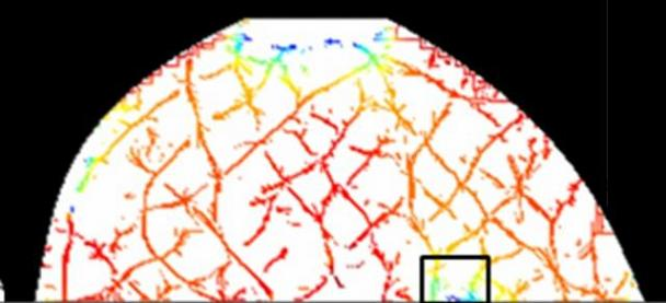 An optical mammography image shows hemoglobin oxygenation of a duct carcinoma in situ (DCIS)--a breast cancer in the lining of the milk ducts that has not yet invaded nearby tissues. The boxed area corresponds to the cancer location and indicates lower values of hemoglobin oxygenation. For cancerous tissue that is associated with abnormal hemoglobin concentration and oxygenation, optical mammography can be used to help diagnose breast cancer and also indicate how well a patient responds to breast cancer chemotherapy. (Courtesy Tufts University)