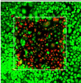 A laser-irradiated area in tissue (within the white square) shows live cancer cells (green) as well as cancer cells that have been killed (red) as a result of the irradiation.