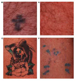 Multicolor tattoos are shown before (M, O) and after (N, P) treatment with a dual-wavelength Nd:YAG laser. Black inks are removed extremely well, but some blue and green inks remain. Multicolor tattoos are shown before (M, O) and after (N, P) treatment with a dual-wavelength Nd:YAG laser. Black inks are removed extremely well, but some blue and green inks remain.