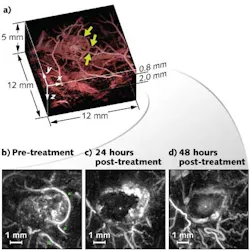 Photoacoustic imaging clearly identifies changes in blood vessels that feed a cancer tumor after administration of a therapeutic vascular disruption agent. The technique penetrates tissue to depths of 10 mm. Photoacoustic imaging clearly identifies changes in blood vessels that feed a cancer tumor after administration of a therapeutic vascular disruption agent. The technique penetrates tissue to depths of 10 mm.