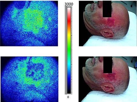 Laser speckle imaging (LSI) now provides real-time monitoring of blood photocoagulation in response to laser therapy of port wine stain (PWS) birthmarks. Actual images (right) and speckle flow imaging (SFI) diagrams (left) from the real-time video feed show an adult male before (upper) and after (lower) treatment on the left temple using a 585 nm pulsed-dye laser. The treatment showed a 37% improvement according to the SFI diagram.