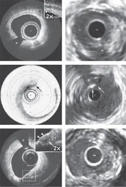 FIGURE 1. Comparing OCT (left) and intravenous ultrasound (IVUS) imagery of the same artery demonstrates the vast difference in resolution. FIGURE 1. Comparing OCT (left) and intravenous ultrasound (IVUS) imagery of the same artery demonstrates the vast difference in resolution.
