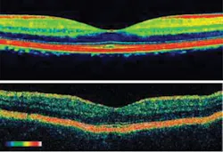 FIGURE 2. Fourier domain (bottom) provides a higher resolution than time domain (top) OCT, but the biggest difference between the two approaches is speed. FIGURE 2. Fourier domain (bottom) provides a higher resolution than time domain (top) OCT, but the biggest difference between the two approaches is speed.