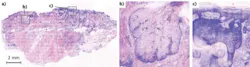 FIGURE 2. A multimodal confocal mosaic of superficial basal cell carcinoma shows, at full scale (a), the equivalent of 2X histology. Zoomed-in views show a normal sebaceous gland (b) and superficial basal cell carcinoma tumor budding off the epidermis (c). FIGURE 2. A multimodal confocal mosaic of superficial basal cell carcinoma shows, at full scale (a), the equivalent of 2X histology. Zoomed-in views show a normal sebaceous gland (b) and superficial basal cell carcinoma tumor budding off the epidermis (c).