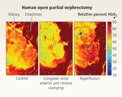 FIGURE 1. Hyperspectral imaging provides a quantitative measure of blood flow to tissue. In the case of kidney surgery, clinicians can monitor tissue oxygenation levels and move more quickly if the tissue becomes at risk for damage (red pixels correspond with high levels of oxygenation while greens and blues correspond with low levels). Imaged at rest (left), and later during surgery, when renal arterial and venous occlusion occurred, a kidney exhibits a decrease in tissue oxygenation (center). Once blood flow to the kidney is restored, the percentage of oxyhemoglobin normalizes (right). FIGURE 1. Hyperspectral imaging provides a quantitative measure of blood flow to tissue. In the case of kidney surgery, clinicians can monitor tissue oxygenation levels and move more quickly if the tissue becomes at risk for damage (red pixels correspond with high levels of oxygenation while greens and blues correspond with low levels). Imaged at rest (left), and later during surgery, when renal arterial and venous occlusion occurred, a kidney exhibits a decrease in tissue oxygenation (center). Once blood flow to the kidney is restored, the percentage of oxyhemoglobin normalizes (right).