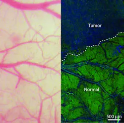 The view of the brain that neurosurgeons currently see during an operation using brightfield microscopy (left); at right, an SRS microscopy view of the same area of brain—in this case, a mouse brain that has had human brain tumor tissue transplanted into it. SRS might someday allow surgeons to see this same view of patients' brains. The view of the brain that neurosurgeons currently see during an operation using brightfield microscopy (left); at right, an SRS microscopy view of the same area of brain—in this case, a mouse brain that has had human brain tumor tissue transplanted into it. SRS might someday allow surgeons to see this same view of patients' brains.
