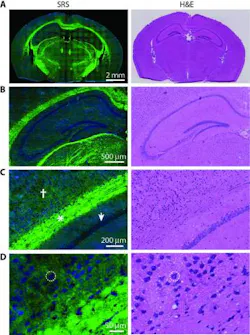 The same areas of brain, imaged with SRS microscopy (left) and conventional H&E staining (right), which is the current technique used to diagnose brain tumors at the tissue level. The research suggests that SRS microscopy could be as accurate as H&E staining in allowing doctors to see tumors, without having to remove tissue or inject dyes into the patient. The same areas of brain, imaged with SRS microscopy (left) and conventional H&E staining (right), which is the current technique used to diagnose brain tumors at the tissue level. The research suggests that SRS microscopy could be as accurate as H&E staining in allowing doctors to see tumors, without having to remove tissue or inject dyes into the patient.