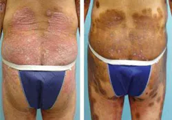 Th 0807bow Lasertreat01 Th 0807bow Lasertreat01