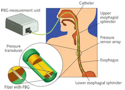 FIGURE 3. A DTG-based fiber-optic pressure sensor monitors operation of the human esophagus. FIGURE 3. A DTG-based fiber-optic pressure sensor monitors operation of the human esophagus.