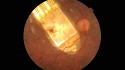 The retinal implant is in place in the patient's eye. (Image credit: University of Oxford) The retinal implant is in place in the patient's eye. (Image credit: University of Oxford)
