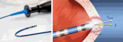 FIGURE 3. A fiber-optic intra-aortic force sensing catheter probe enables real-time monitoring of the force exerted against the heart wall by the catheter. FIGURE 3. A fiber-optic intra-aortic force sensing catheter probe enables real-time monitoring of the force exerted against the heart wall by the catheter.