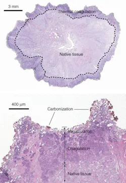 FIGURE 1. Using a 110-W thulium fiber laser operating at 1.9 µm, researchers rapidly vaporized prostate tissue at a rate of 0.83 ± 0.11 g/min and with a thermal coagulation zone of 500 to 2000 µm, demonstrating the potential for hemostasis. FIGURE 1. Using a 110-W thulium fiber laser operating at 1.9 µm, researchers rapidly vaporized prostate tissue at a rate of 0.83 ± 0.11 g/min and with a thermal coagulation zone of 500 to 2000 µm, demonstrating the potential for hemostasis.