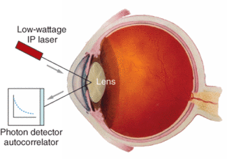 Quasi-elastic light-scattering may allow early diagnosis of Alzheimer's disease by detecting protein aggregates at the internal periphery of the lens.