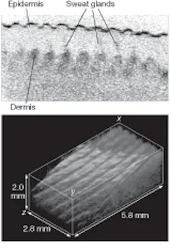 A human finger is imaged in vivo without horizontal scanning by using an axial-lateral parallel time-domain optical-coherence-tomography technique (top) at an acquisition rate of 1/1500 s to gather 512 x 512-pixel image information. Horizontal scanning then allows capture and computation of a 3-D image (bottom) that represents a total volume of 5.8 x 2.8 x 2.0 mm3. A human finger is imaged in vivo without horizontal scanning by using an axial-lateral parallel time-domain optical-coherence-tomography technique (top) at an acquisition rate of 1/1500 s to gather 512 x 512-pixel image information. Horizontal scanning then allows capture and computation of a 3-D image (bottom) that represents a total volume of 5.8 x 2.8 x 2.0 mm3.