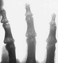 A human hand is imaged in x-rays using Polaroid film 30 cm behind the source, a carbon-nanotube field-emission cathode. Because of limitations of the power supply and vacuum feed-through, the acceleration voltage was set at 14 kV, lower than the 50 to 100 kV commonly used for medical imaging. Detailed bone structures are clearly resolved The CNTs used in the x-ray experiment measure approximately 1.4 nm in diameter. A human hand is imaged in x-rays using Polaroid film 30 cm behind the source, a carbon-nanotube field-emission cathode. Because of limitations of the power supply and vacuum feed-through, the acceleration voltage was set at 14 kV, lower than the 50 to 100 kV commonly used for medical imaging. Detailed bone structures are clearly resolved The CNTs used in the x-ray experiment measure approximately 1.4 nm in diameter.